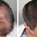 PROGRAMME DE RECONSTRUCTION CAPILLAIRE
